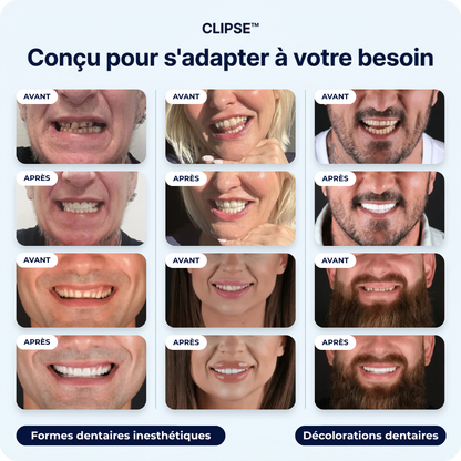 Faccette Dentali Smilavea