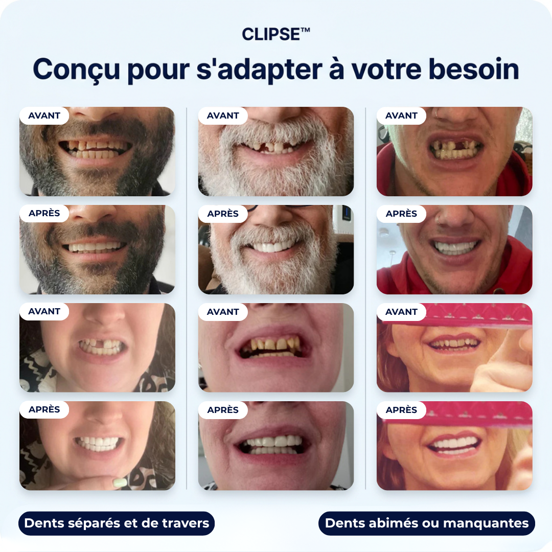 Faccette Dentali Smilavea