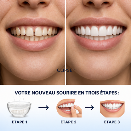 Faccette Dentali Smilavea